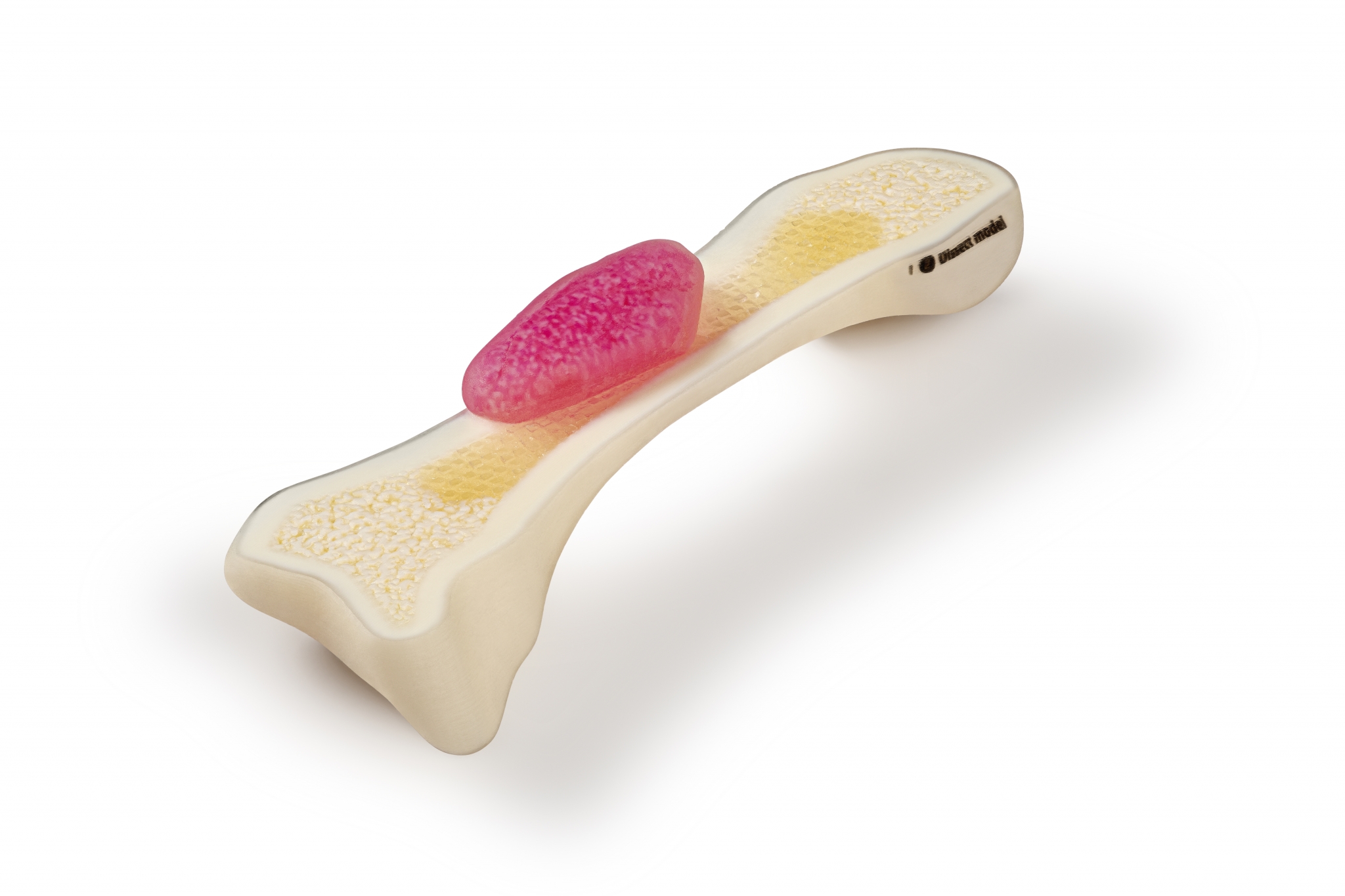 3D-printed bone with tumour